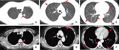 Multiple pulmonary cavernous haemangiomas with concurrent primary pulmonary adenocarcinoma: a case report and literature review